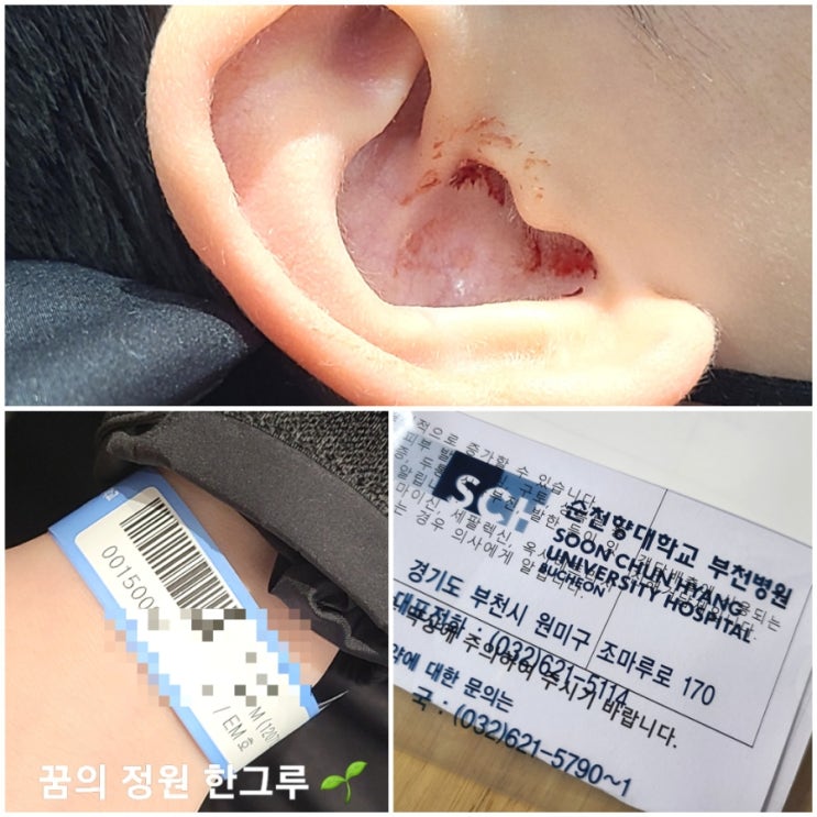  귀에서 피 독감 급성중이염 증상 인천 휴일 병원 주말 순천향대학교 부천병원 응급실 비용 솔직후기