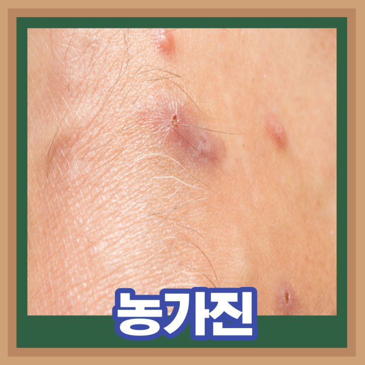  유아 아기 성인 농가진 원인 증상 전염 흉터 고름 치료 항생제 연고