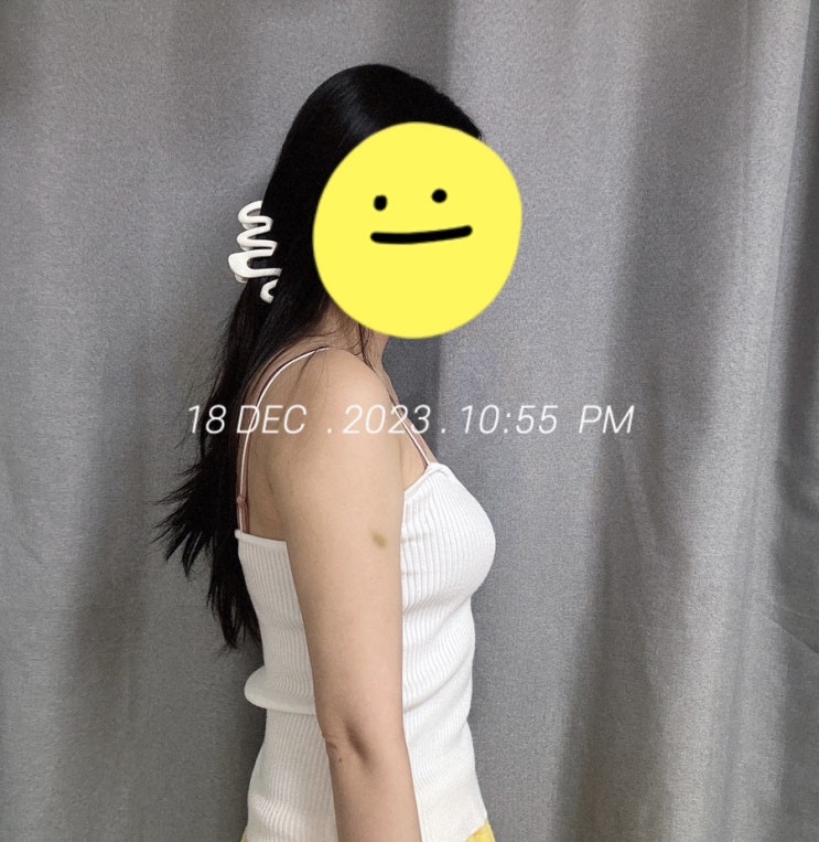  천안 지방추출주사 팔뚝 4주차 후기