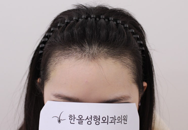  20대 여성 헤어라인 비절개 3000모 2주 경과