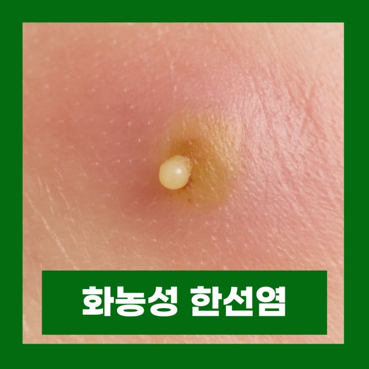  화농성 한선염 증상 원인 겨드랑이 엉덩이 종기 치료 수술