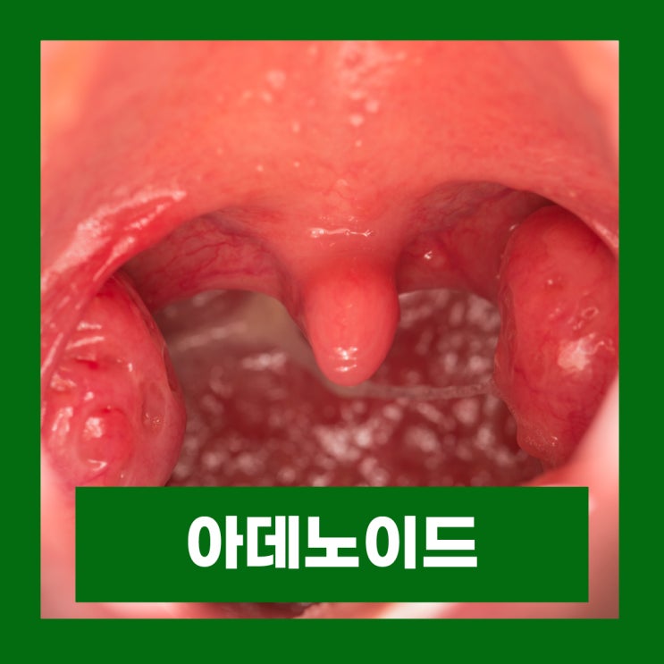  아데노이드 비대증 증상 어린이 편도 수술