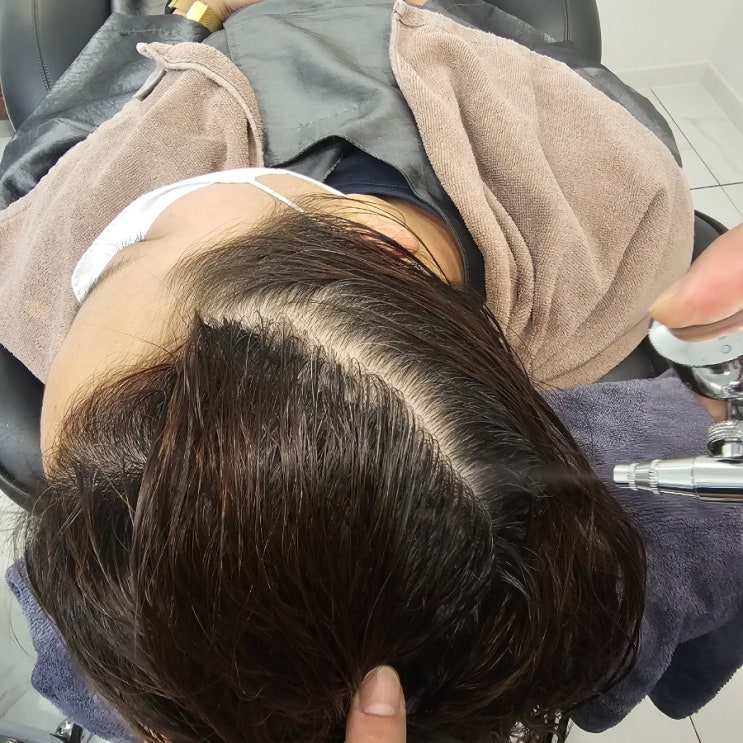  [성남] 야탑탈모 더마힐 MGF 두피탈모전문센터 후기