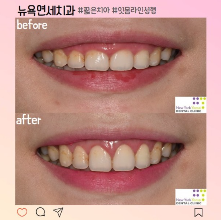  압구정 잇몸성형전문치과 웃을 때 과한 잇몸 거미스마일 해결 방법