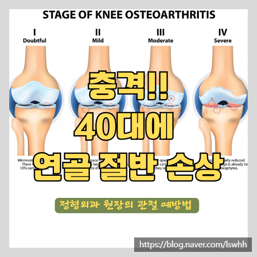  뮤코다당 콘드로이친으로 퇴행성 관절염을 예방하고 관절영양제 잘 고르는 방법