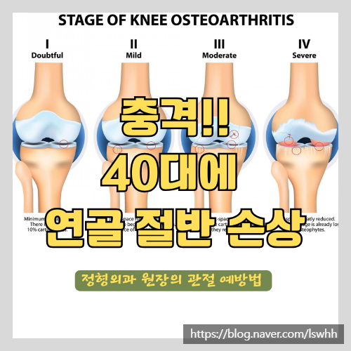 뮤코다당 콘드로이친으로 퇴행성 관절염을 예방하고 관절영양제 잘 고르는 방법