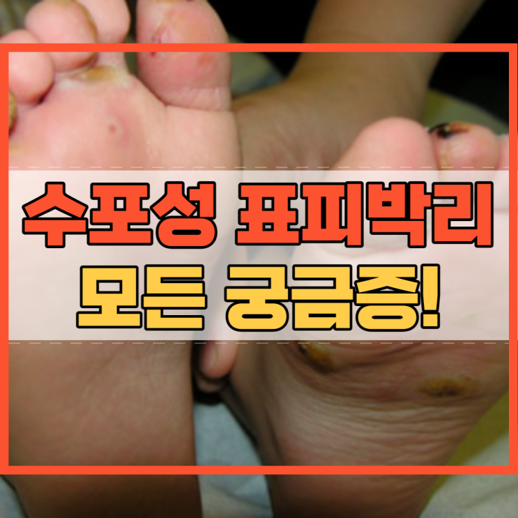  수포성 표피박리증 유형 증상 특징 진단 치료 예방 궁금증!