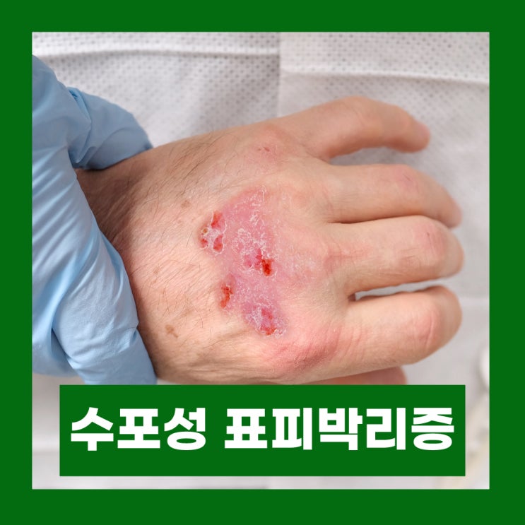  수포성 표피박리증 종류 치료제 이효리 비행기 옆자리 희귀병 유튜버