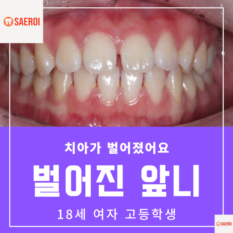  앞니 벌어짐, 치아 벌어짐(spacing) 교정 / 18세 여자 고등학생