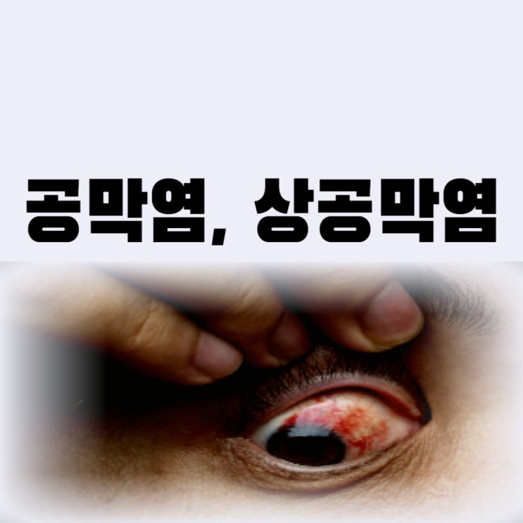  공막염 상공막염 증상 치료 자가면역질환 때문에