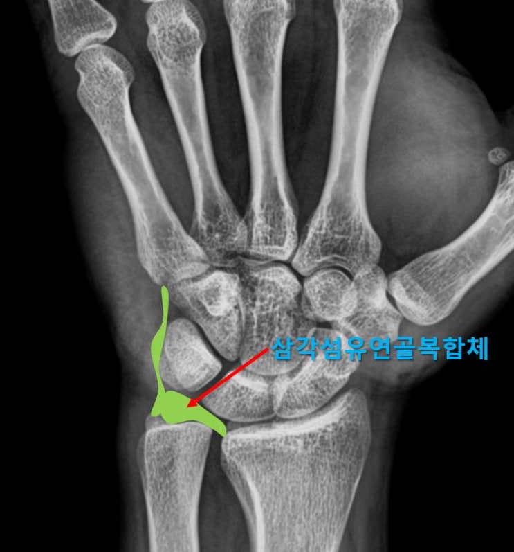  광주광역시 정형외과, 손목 통증으로 시험에서 떨어졌어요