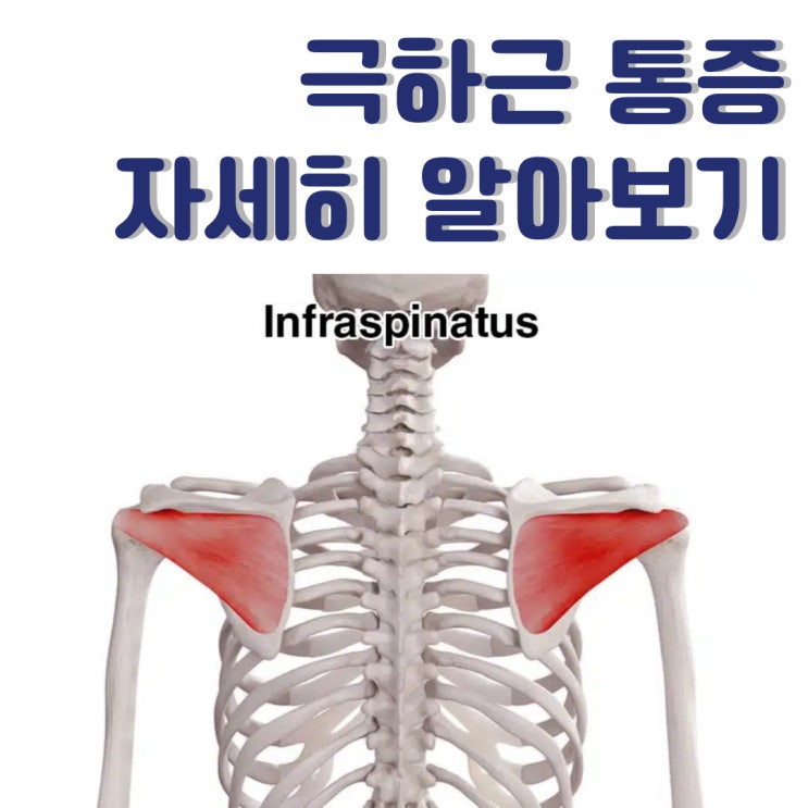  극하근통증이 생기는 이유 4가지! 그리고 통증 줄이는 방법