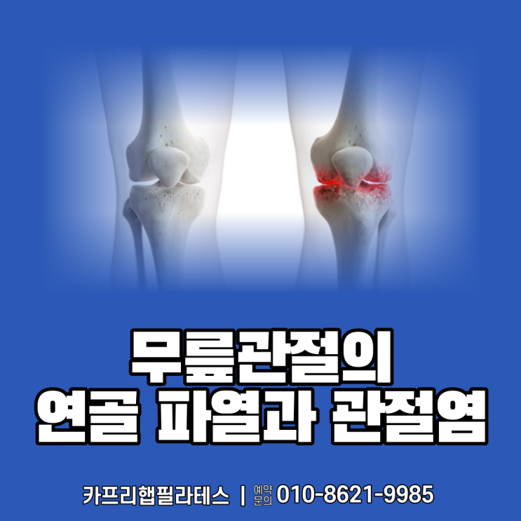  【약수역재활PT】 무릎 연골(반월판) 파열과 관절염