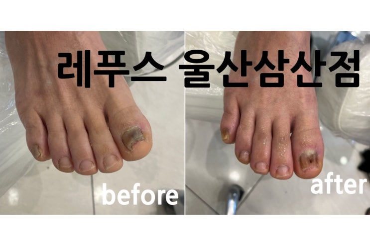  레푸스 울산 삼산점 무좀 내성발톱 발각질 굳은살 깨끗하게 시원하게