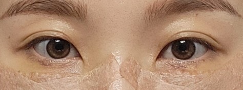  내돈내산 눈밑지방재배치+미세지방이식 3~6일차 후기 (2)