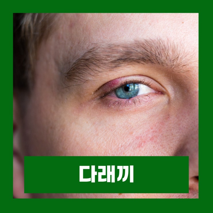 눈 다래끼 초기증상 빨리 낫는법 겉 속 콩 다래끼 종류