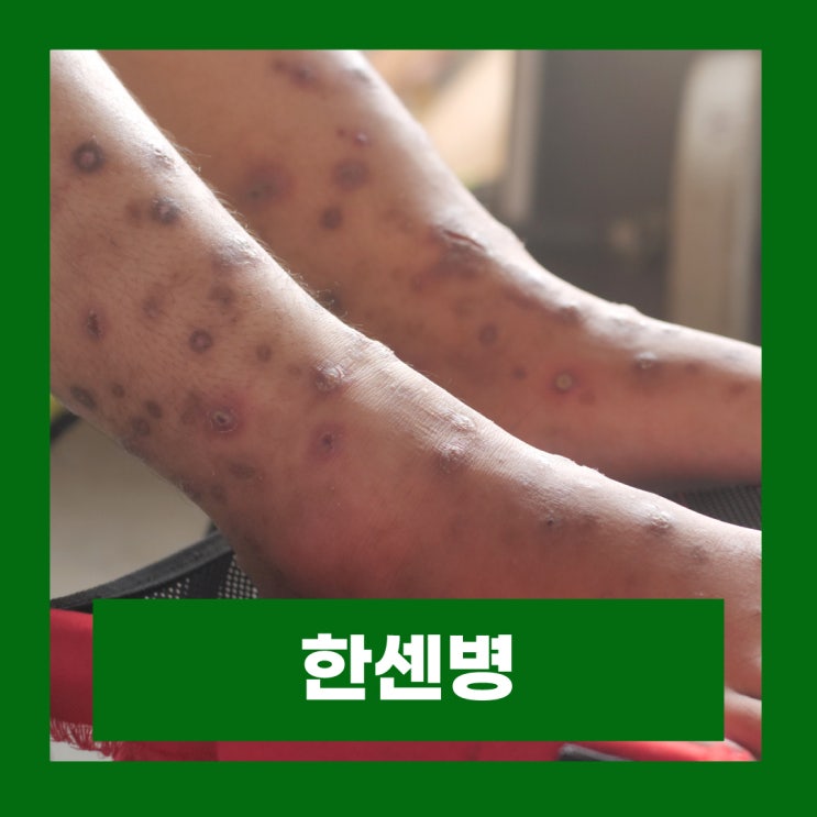  한센병 전염 원인 나병 문둥병 증상 소록도 한센병 치료