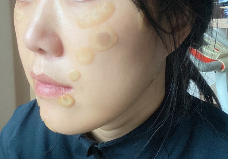  전주 흑자제거 리팟레이저 11일째 재생테이프 붙이고 있는 중 (제거확인 후 재포스팅 예정)