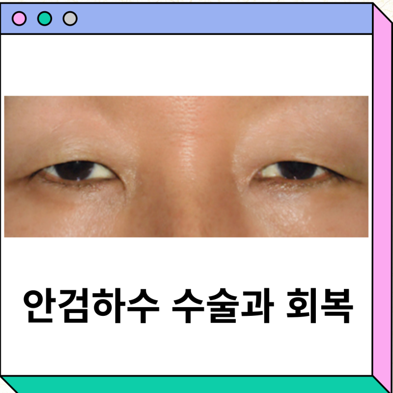 안검하수 수술 자가 진단 회복 기간 전후 운동