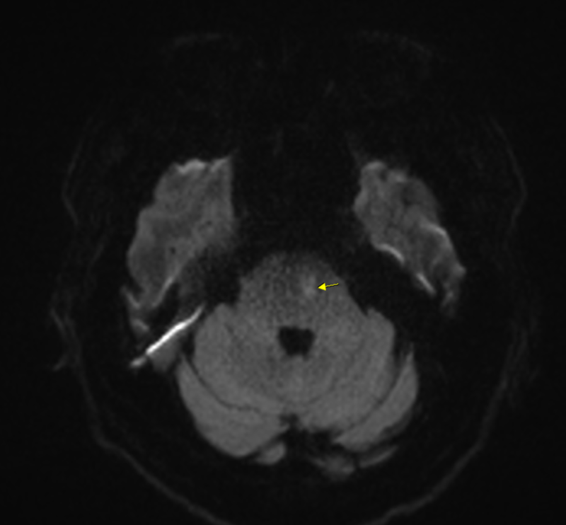 [병원일기] Rt pons infarction : 네이버 블로그