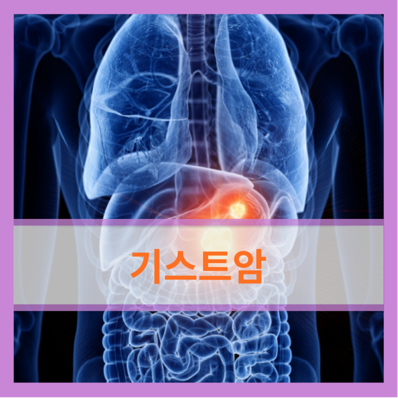 기스트암 희귀병 암 남우현 GIST 원인 증상 수술 치료