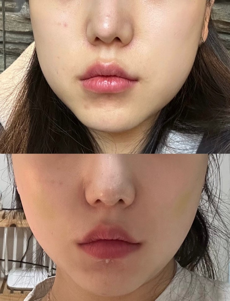 민트실리프팅 후기 당일~2주 얼굴 붓기, 멍, 통증, 부작용 관리 방법