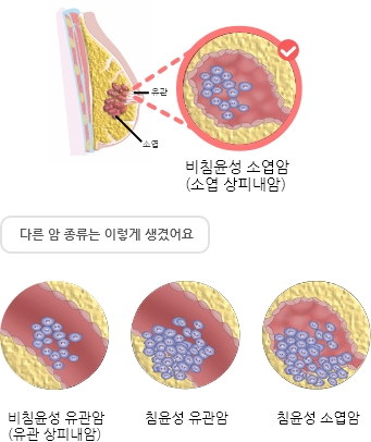  암 종류 - 소엽 상피내암