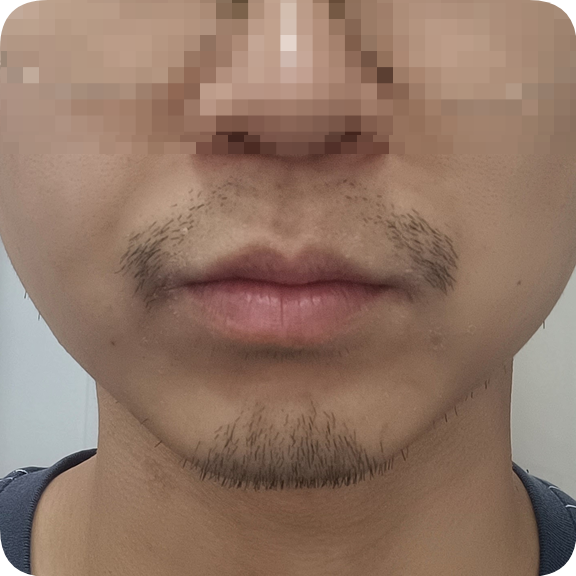  은평구 왁싱 남자 수염 제모 꿀팁 썰. 단비뷰티_헤어