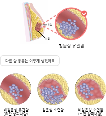  암 종류 - 침윤성 유관암