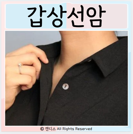  갑상선암 결절 목소리 장애 원인 증상