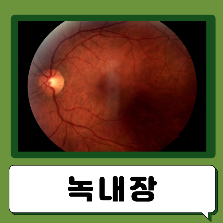  녹내장 초기증상 원인 진단 검사 치료, 녹내장 안압 시야