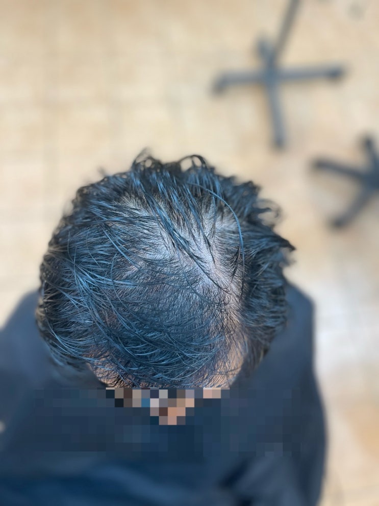  심한 남자탈모펌 입금전 입금후 탈모전문 부산사상 르네시떼 6층 헤어/ 주례감전하단다대명지김해장유녹산용원화명덕천모라만덕부암서면양정연제동래사직명륜연산수영망미해운대송정감천남포초량구덕