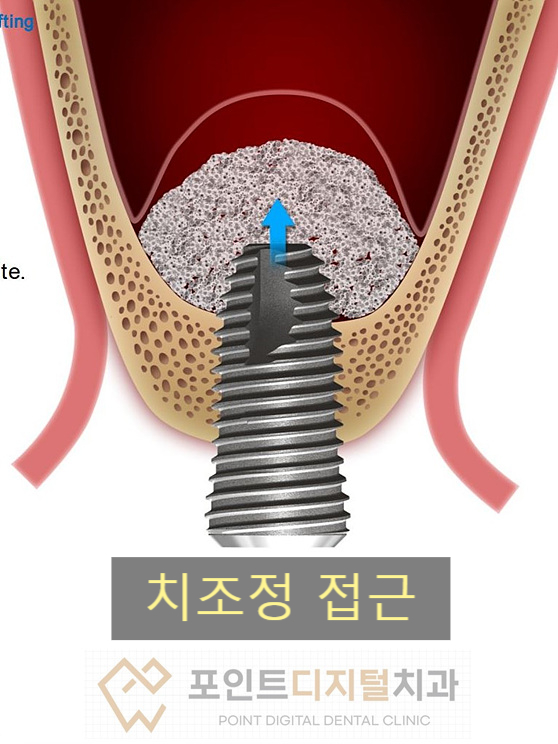  [탕정치과] 상악동 거상(뼈이식) 방법들 / 천안 아산