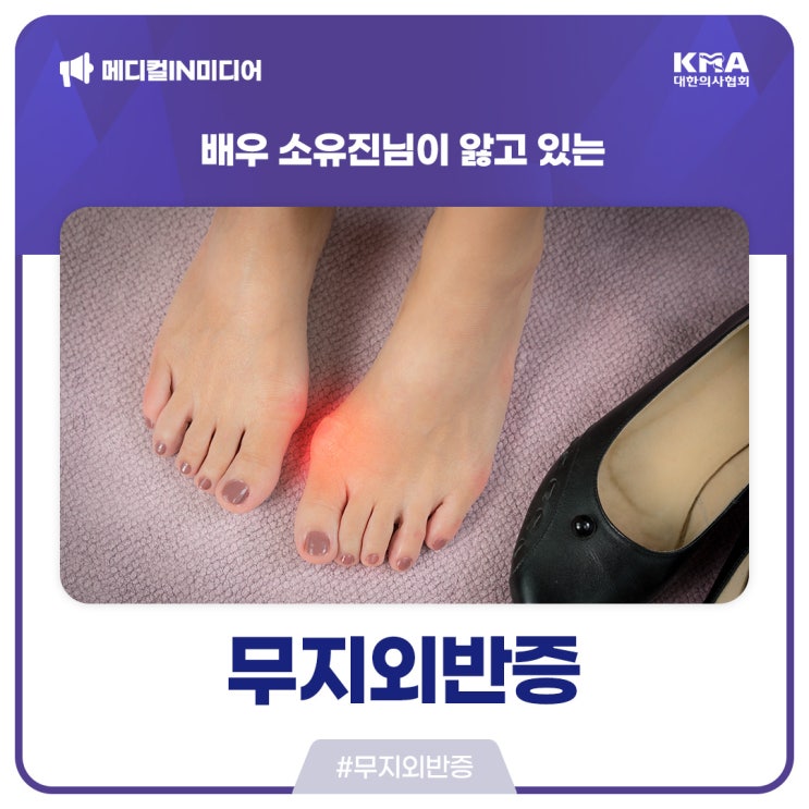  [메디컬IN미디어] 배우 소유진님이 앓고 있는 무지외반증이란?