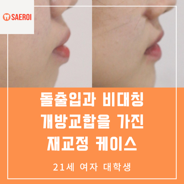  돌출입과 비대칭 개방교합을 가진 재교정 케이스 / 21세 여자 대학생