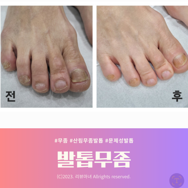  신림 무좀발톱_한병병원 치료 후기