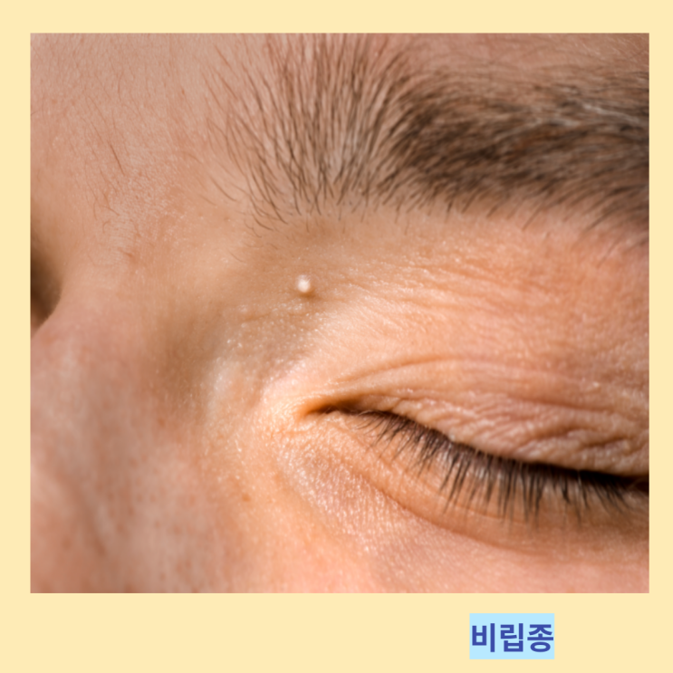 얼굴 눈 눈가 비립종 원인 및 올바른 관리법 얼굴 눈 눈가 비립종 원인 및 올바른 관리법