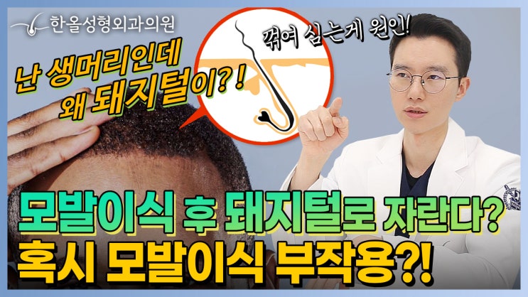  [한올성형외과] 모발이식 후 일명 돼지털, 곱슬머리가 나오는 이유는? 혹시 모발이식 부작용?!