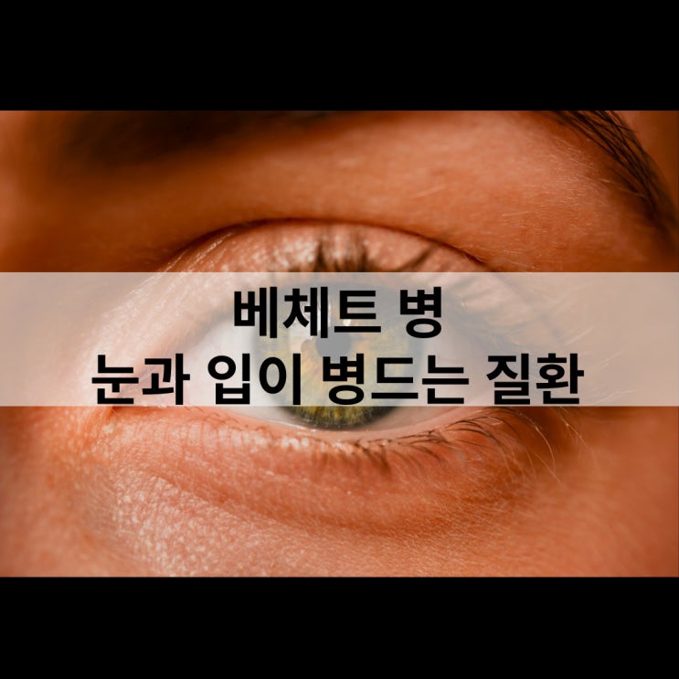  베체트병 눈, 구강, 음부에 발생하는 염증 질환