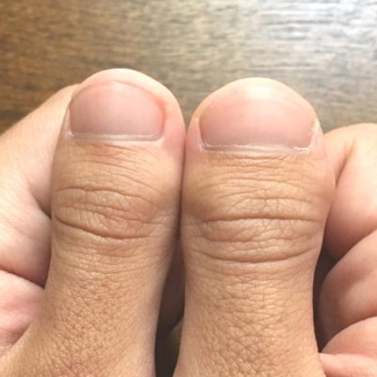  개구리 손톱: 원인부터 교정까지, 알아야 할 모든 것