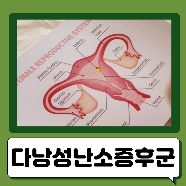  다낭성 난소 증후군 원인 증상 검사 치료법 생리불순 생리 늦어짐 다모증
