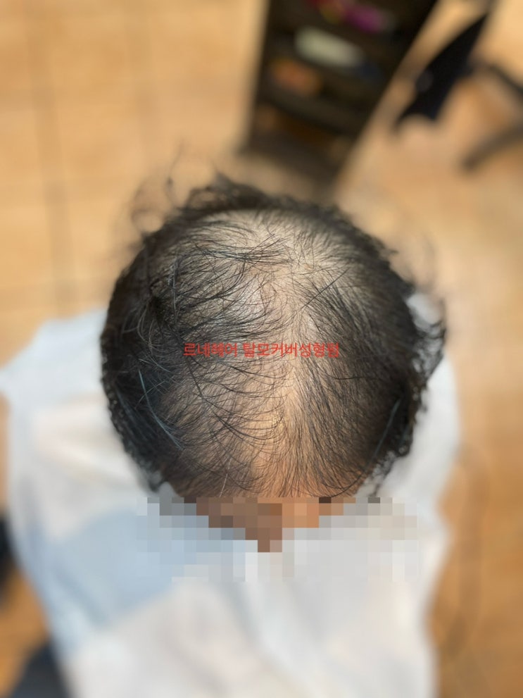  남자심한탈모 중년탈모 탈모히든성형펌과 해독염색 부산사상 르네시떼 미용실/ 주례감전개금화명김해울산양산진해용원명지동래해운대덕천수영망미광안기장장유연산연제금정구덕남포초량안락충렬가야서면