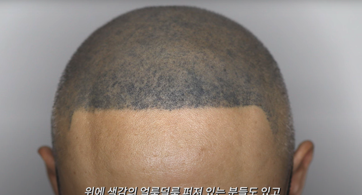  smp 두피문신 부작용 총정리 (원인, 피하는 법 등)
