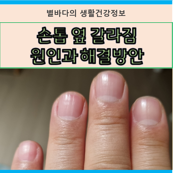손톱 옆 갈라짐 원인과 해결 방안