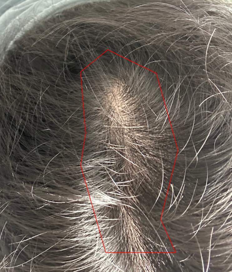 엠자형 앞머리, 가마, 가르마 부분 탈모약, 73일 복용 후기 엠자형 앞머리, 가마, 가르마 부분 탈모약, 73일 복용 후기