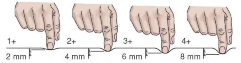 요흔성 부종 pitting edema :: 원인, 증상, 단계, 치료 및 관리법 : 네이버 블로그