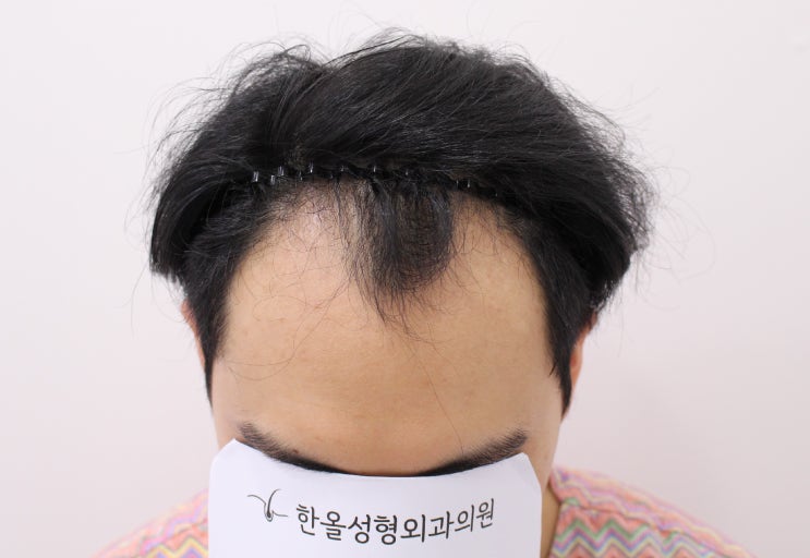  20대 남성 M자 탈모 헤어라인 비절개 4000모 2주 경과