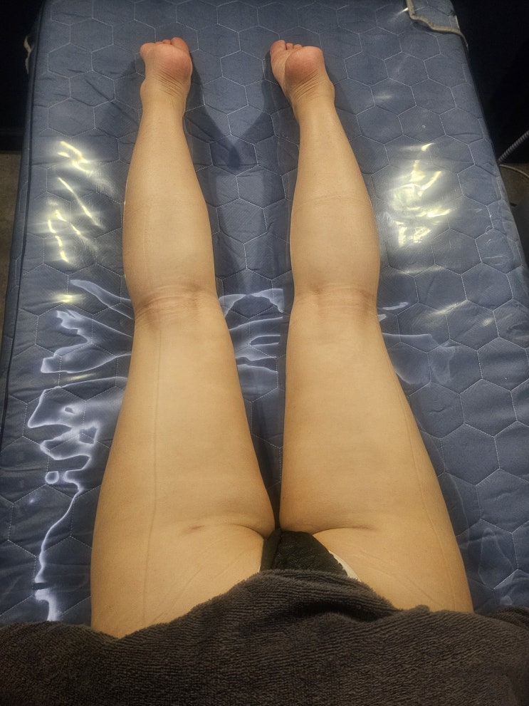  허벅지 지방흡입 멍과 붓기 '이곳'을 풀어주어야 빠르게 회복됩니다.