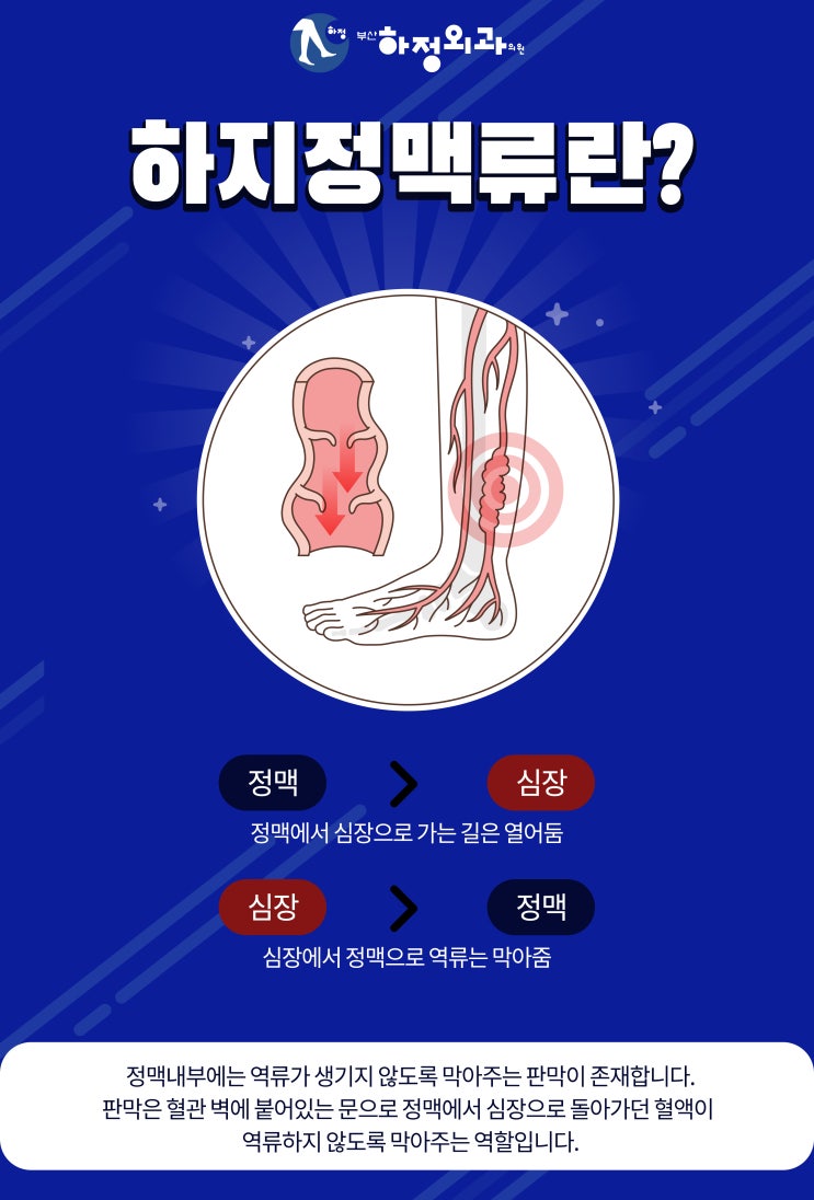  하지정맥류 허벅지 실핏줄 원인과 개선방법은?