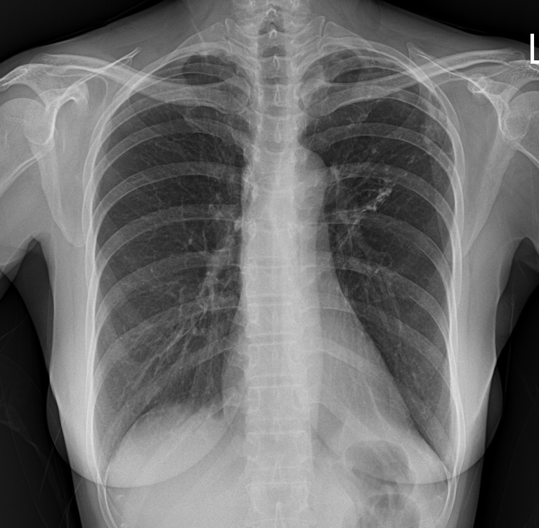 [흉선암] 엑스레이에서 보이지 않은 흉선암(Thymic carcinoma) : 네이버 블로그